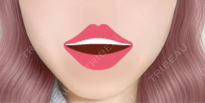 ボトックス（エラ・小顔） 共立美容外科 名古屋院 BEFORE メイン用