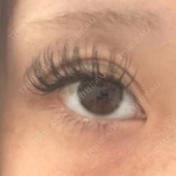 ヒアルロン酸注入（涙袋） ルラ美容クリニック 大宮院 / ルラスキンクリニック 大宮院 BEFORE メイン用