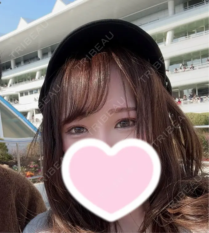 ヒアルロン酸注入（頬） / ヒアルロン酸注入（鼻翼基部） おおたかの森ビューティークリニック BEFORE メイン用