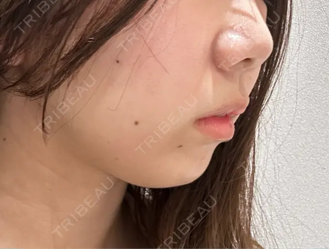その他（輪郭） BITO BEAUTY CLINIC BEFORE メイン用