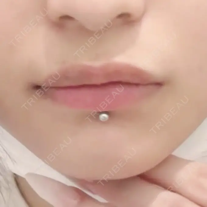 ボトックス（エラ・小顔） / ヒアルロン酸注入（唇） / ボトックス（口角） / ヒアルロン酸注入（目の下） / ポテンツァ TCB東京中央美容外科 水戸院 BEFORE メイン用