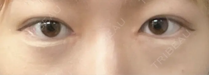 クマ治療 / ヒアルロン酸注入（目の下） BITO BEAUTY CLINIC BEFORE メイン用