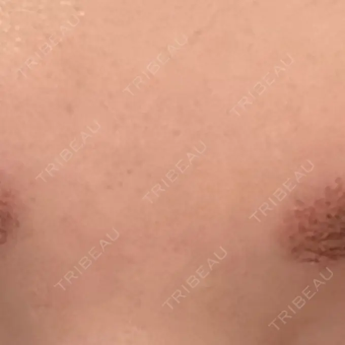 美容点滴・美容注射（美肌） 城本クリニック 名古屋院 BEFORE メイン用