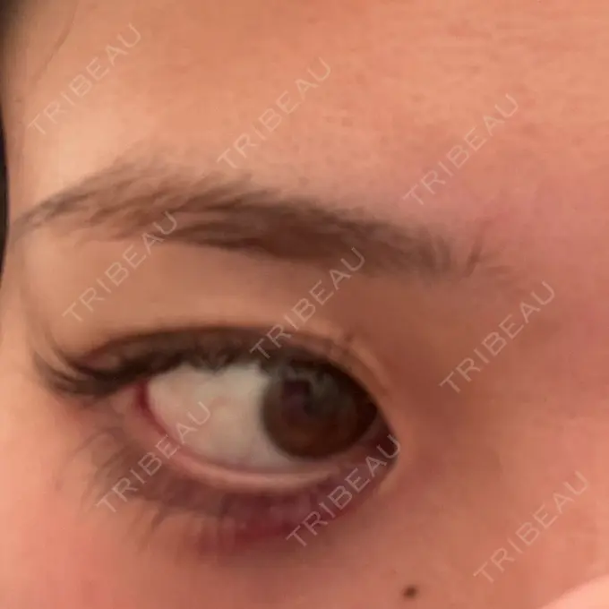 ヒアルロン酸注入（涙袋） / 肌ヒアルロン酸注入（たるみ・シワ改善） / ヒアルロン酸注入（唇） / ヒアルロン酸注入（目の下） 共立美容外科 神戸三宮院 BEFORE メイン用