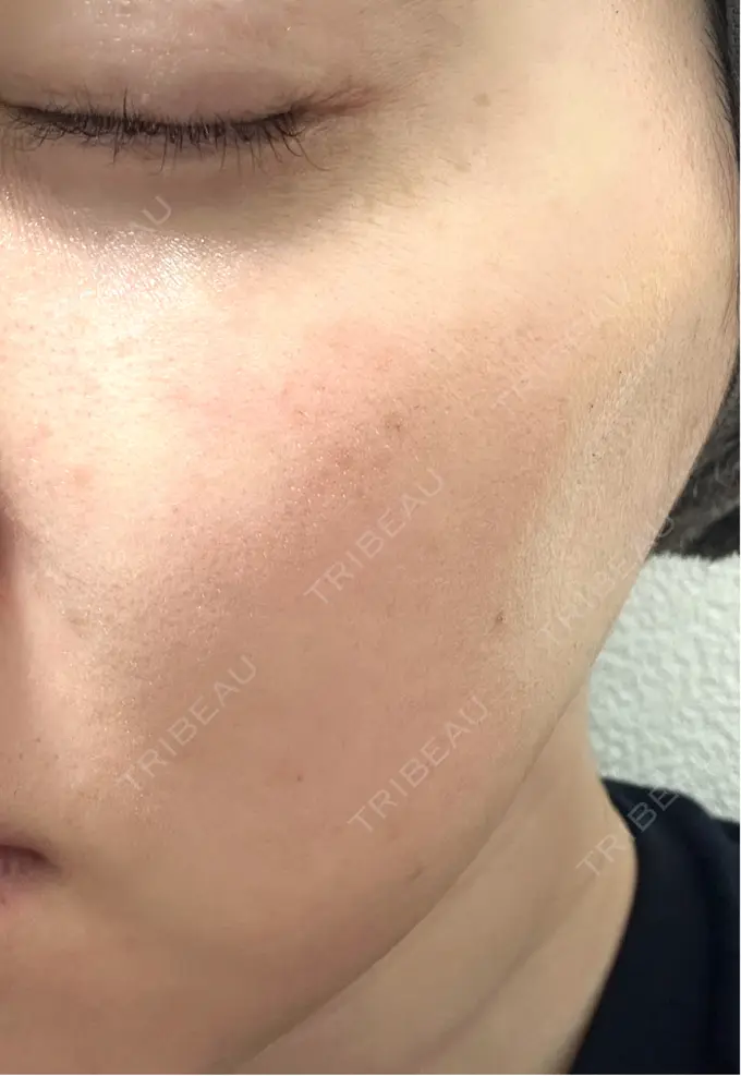 光治療（フォトフェイシャルなど） LiLAスキンクリニック中目黒 BEFORE メイン用