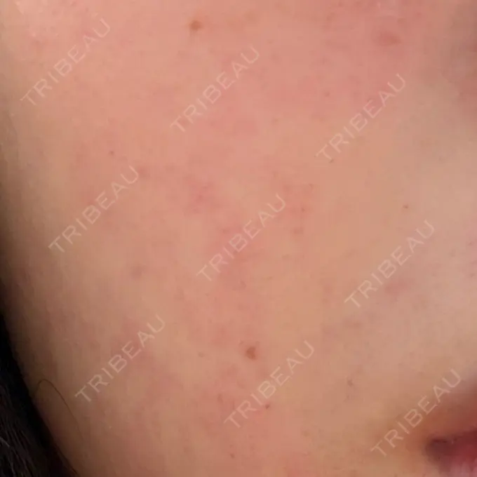 毛穴洗浄（ハイドラフェイシャルなど） / ルメッカ / ピコフラクショナルレーザー（毛穴・ニキビ跡） 東京シルククリニック 東京神田院 BEFORE メイン用