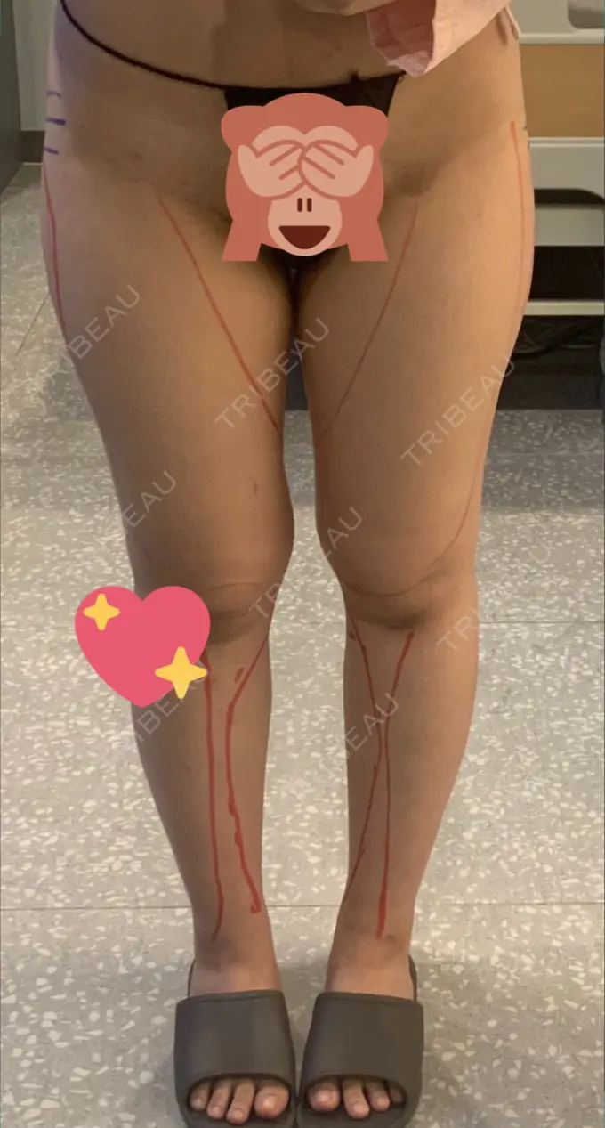 脂肪吸引（脚） / 脂肪吸引（お尻） / ボトックス（ふくらはぎ） / その他（ボディ） YumaStem美容外科 BEFORE メイン用