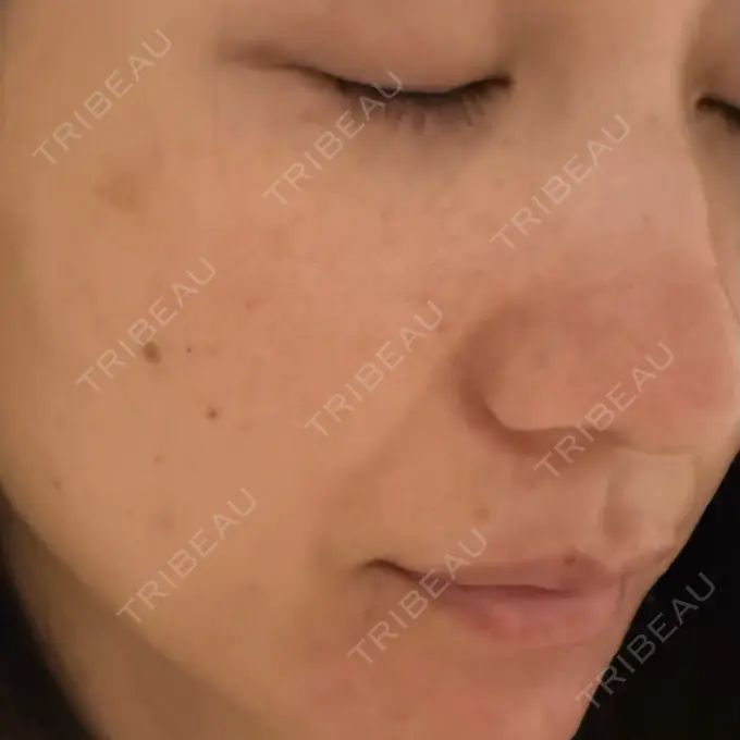 ピーリング（ニキビ・毛穴） / ピコレーザートーニング（美白・肝斑） / ピコフラクショナルレーザー（毛穴・ニキビ跡） ルラ美容クリニック 広島院 BEFORE メイン用