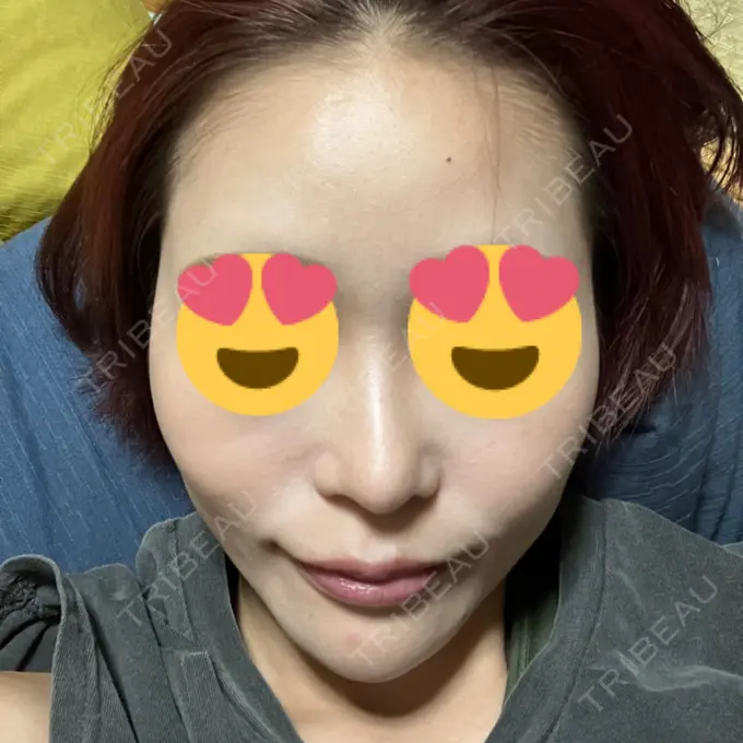 鼻尖形成（切開） / 軟骨移植 表参道ウィズ・クリニック BEFORE メイン用