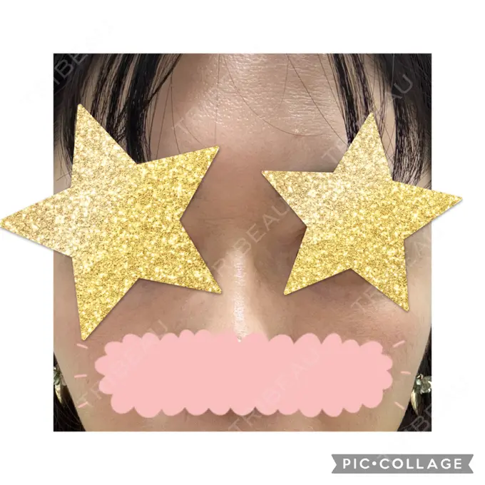 ボトックス（眉間） / ボトックス（目尻） ヴァージンクリニック 福岡天神院 BEFORE メイン用