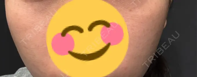 ルメッカ Code Beauty Clinic 名古屋院 BEFORE メイン用