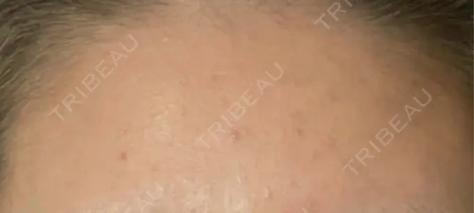 ピーリング（ニキビ・毛穴） EME CLINIC BEFORE メイン用