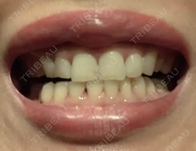 ホワイトニング SK新宿歌舞伎町美容外科・歯科 BEFORE メイン用