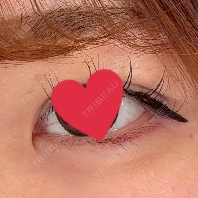 ヒアルロン酸注入（涙袋） / ヒアルロン酸注入（唇） アリエル美容クリニック 横浜院 BEFORE メイン用