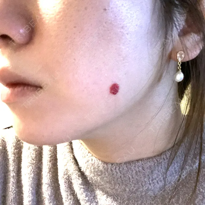 ピコスポット APスキンクリニック銀座 BEFORE メイン用