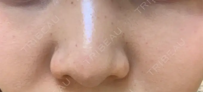 肌育注射（ジュベルックなど） 城本クリニック 名古屋院 BEFORE メイン用