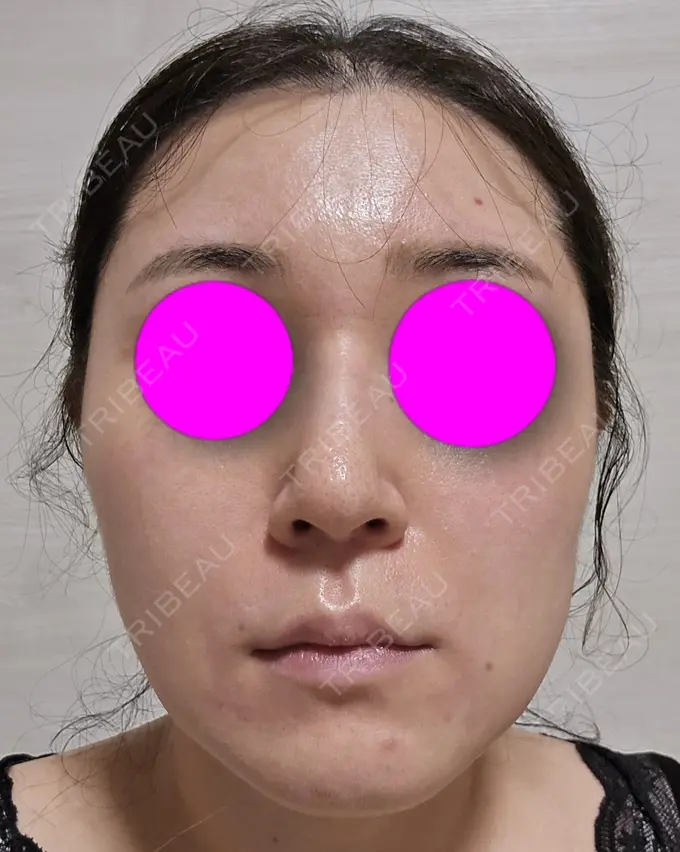 糸リフト / 脂肪吸引（二の腕） / 脂肪吸引（肩） / 脂肪吸引注射（顔） 東京シンデレラ美容外科 池袋院 BEFORE メイン用