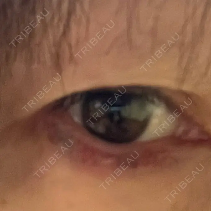 アートメイク除去・修正 Wクリニック 心斎橋院 BEFORE メイン用