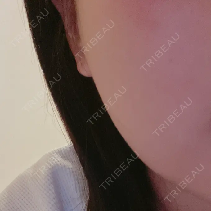 ルメッカ 大美会クリニック 神戸院 BEFORE メイン用