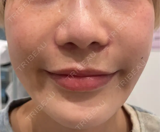 水光注射（ハリ・美肌） 新宿三丁目メディカルクリニック BEFORE メイン用