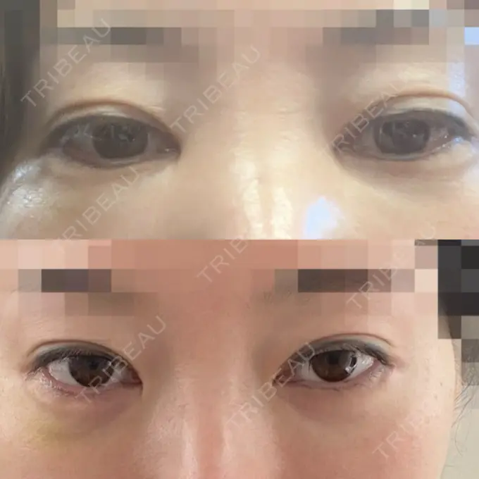 脂肪溶解注射 / 脂肪溶解注射（お腹） / 肌育注射（ジュベルックなど） / 美肌レーザー / RF（高周波）たるみ治療 AB美容クリニック 新宿院 BEFORE メイン用