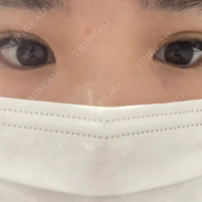 ヒアルロン酸注入（涙袋） アネシス美容クリニック BEFORE メイン用