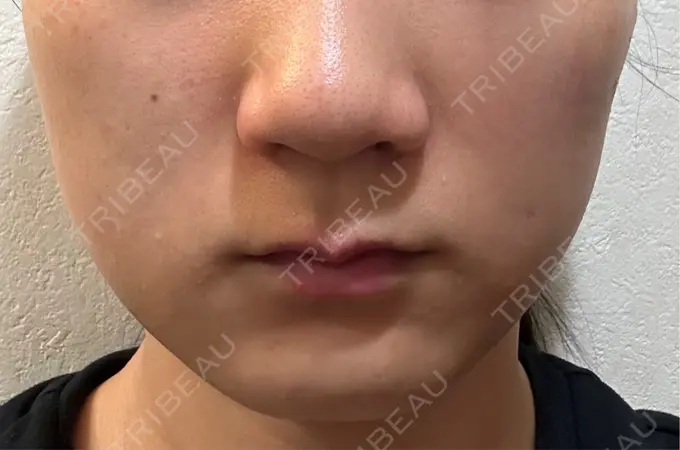 その他（輪郭） 横浜TAクリニック BEFORE メイン用