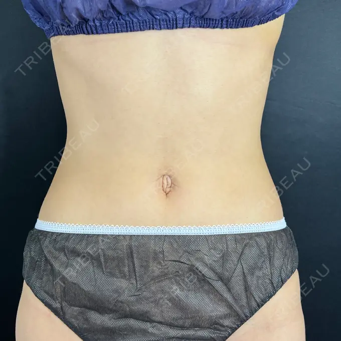 へそ形成 藤・ナチュレ美容クリニック 銀座院 BEFORE メイン用