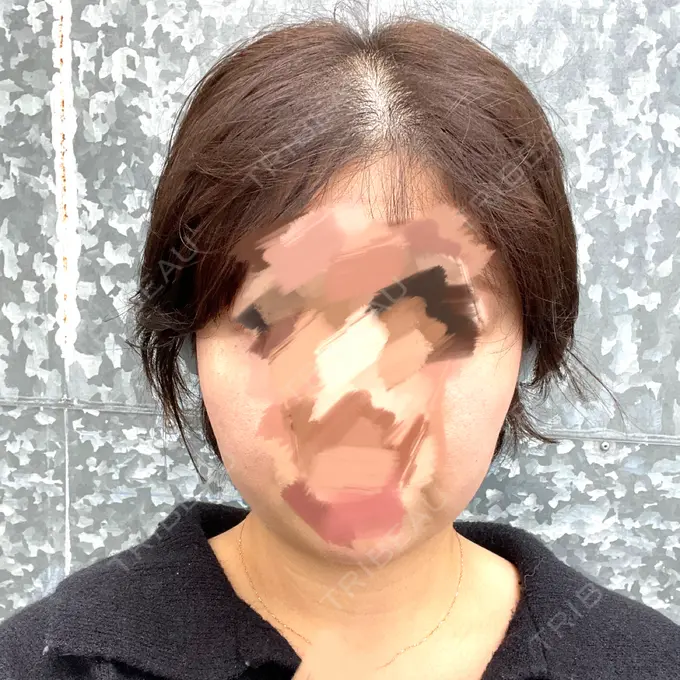 RF（高周波）たるみ治療 ゆきスキンクリニック 東池袋 BEFORE メイン用