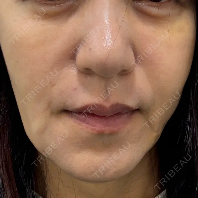 ヒアルロン酸注入（唇） 新未来クリニック BEFORE メイン用