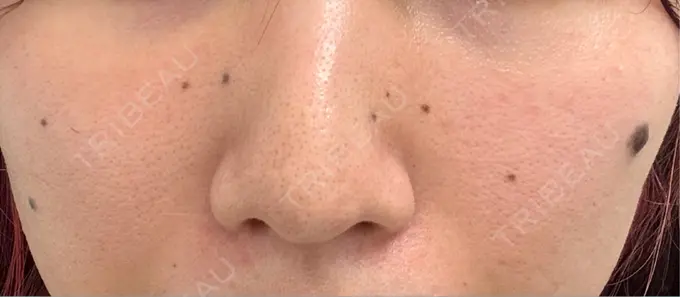 ほくろ・いぼ切除（肌） / ほくろ・いぼ除去レーザー（肌） ガーデンクリニック 名古屋院 BEFORE メイン用