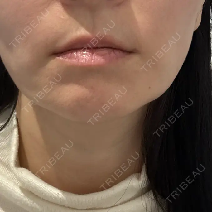 ヒアルロン酸注入（鼻翼基部） ルラ美容クリニック 渋谷本院 BEFORE メイン用