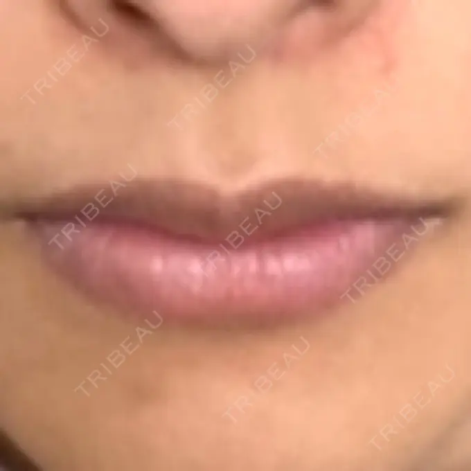 アートメイク（眉） / アートメイク（唇） Tokyo Tensei Clinic 新宿院 BEFORE メイン用