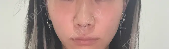 鼻尖形成（切開） / 軟骨移植 / 鼻尖縮小 東京シンデレラ美容外科 大宮院 BEFORE メイン用