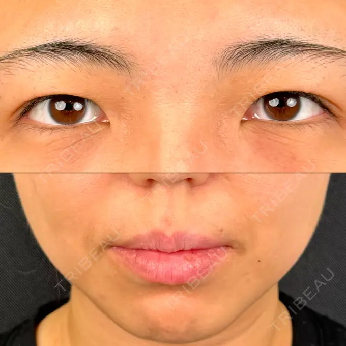二重埋没 / 目頭切開 / 糸リフト / 鼻翼基部形成（貴族手術） / ヒアルロン酸注入（鼻翼基部） 東京シンデレラ美容外科 池袋院 BEFORE メイン用