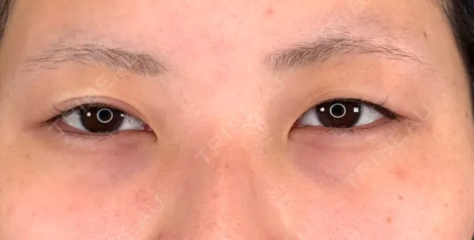 二重埋没 / 上まぶたの脂肪取り アリエル美容クリニック 横浜院 BEFORE メイン用