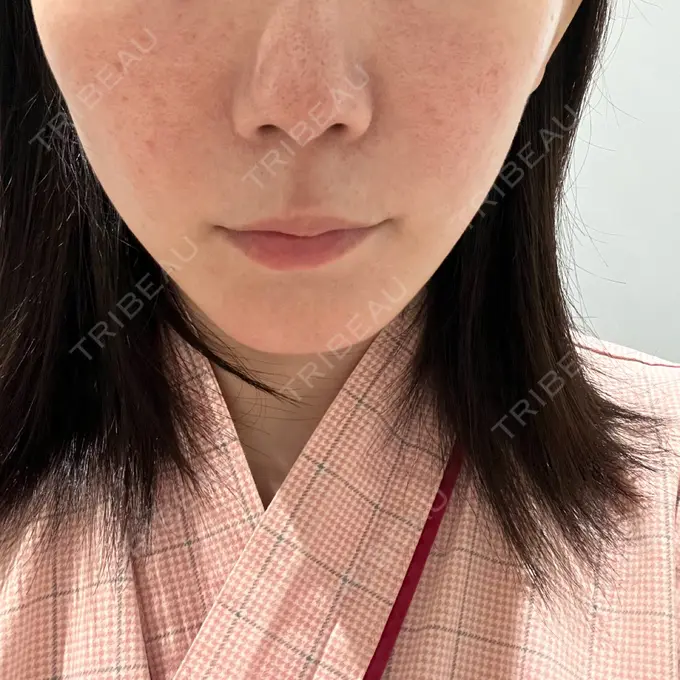 小鼻縮小（切開） / 人中短縮 / 鼻孔縁挙上 / 口角挙上 / ボトックス（口角） / ボトックス（人中） Otus Clinic 【オータスクリニック】 BEFORE メイン用