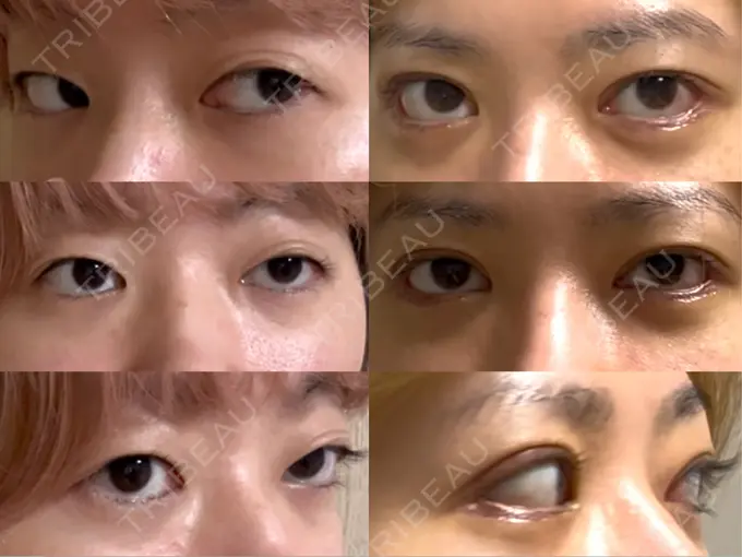 二重切開 / 鼻中隔延長（切開） / 小鼻縮小（切開） / 目尻切開 / 上まぶたたるみ取り / タレ目形成・グラマラスライン（切開） / 鼻翼基部形成（貴族手術） / 鼻柱下降・鼻唇角形成（猫手術） eクリニック 大阪梅田 西日本統括院 BEFORE メイン用