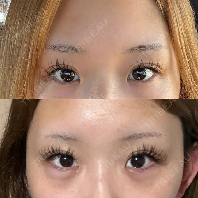 ヒアルロン酸注入（涙袋） Code Beauty Clinic 名古屋院 BEFORE メイン用