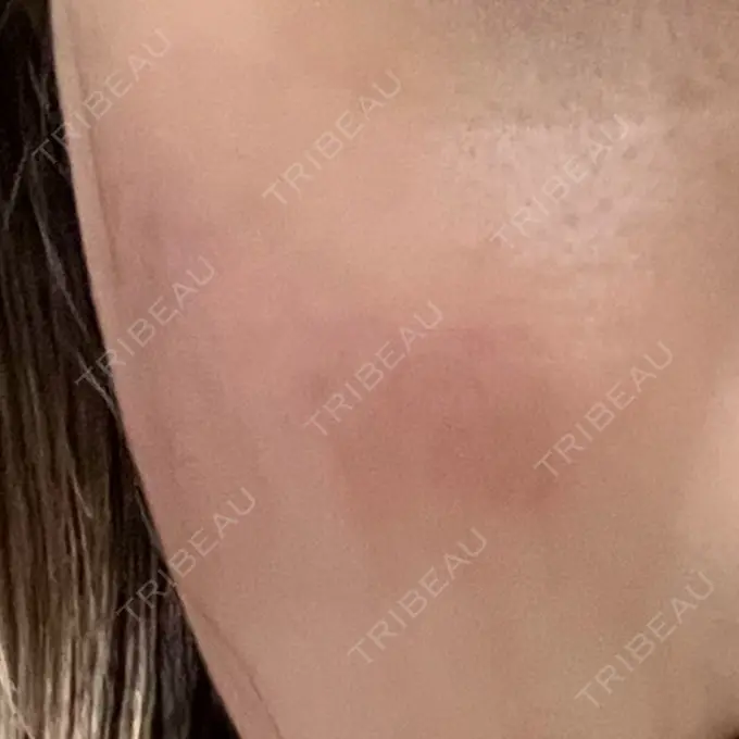 RF（高周波）たるみ治療 豊洲内科・糖尿病 / 形成・美容外科クリニック BEFORE メイン用