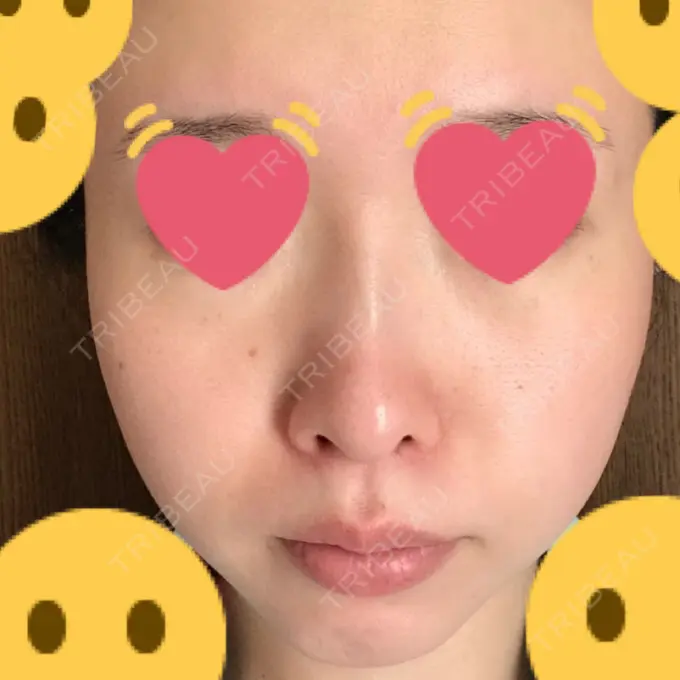 クマ治療 / シミ取りレーザー / その他（目元） 赤坂プレミアクリニック BEFORE メイン用