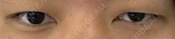 二重埋没 水の森美容クリニック 東京新宿院 BEFORE メイン用