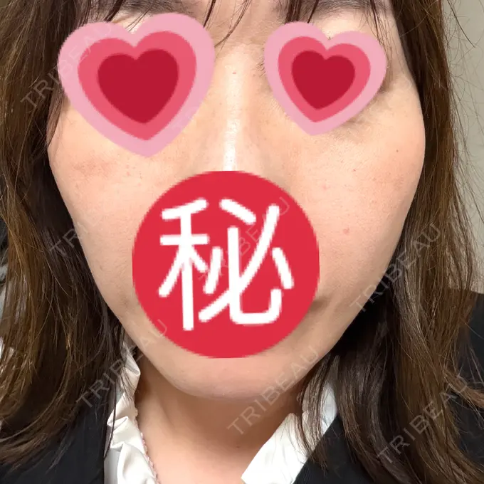 ハイフ（顔） 城本クリニック 立川院 BEFORE メイン用