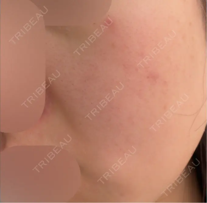 エレクトロポレーション / 毛穴洗浄（ハイドラフェイシャルなど） / 医療脱毛（顔） さっぽろ美容クリニック BEFORE メイン用