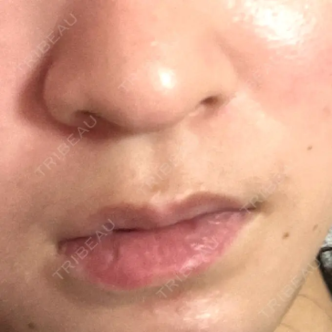 ボトックス（エラ・小顔） / ヒアルロン酸注入（唇） / ボトックス（口角） フィラークリニック 名古屋栄院 BEFORE メイン用