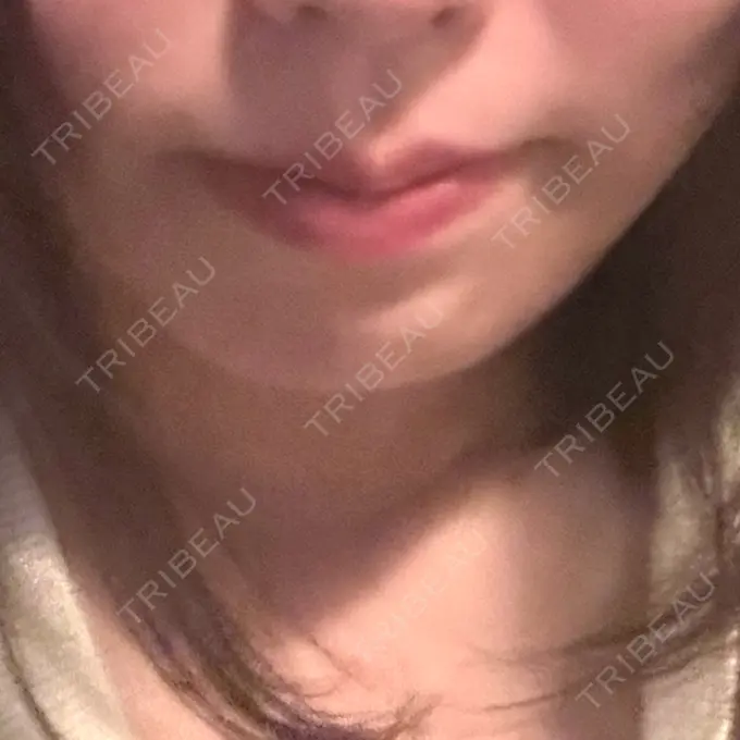 ヒアルロン酸注入（唇） 目白ホワイトクリニック BEFORE メイン用