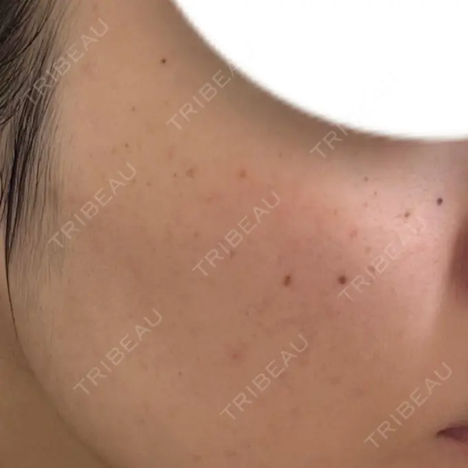 ピーリング（ニキビ・毛穴） / ルメッカ ルラ美容クリニック 大宮院 / ルラスキンクリニック 大宮院 BEFORE メイン用