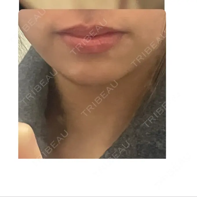 ボトックス（あご） / ボトックス（エラ・小顔） / ボトックス（眉間） / ボトックス（首） DMTC CLINIC 渋谷院 BEFORE メイン用