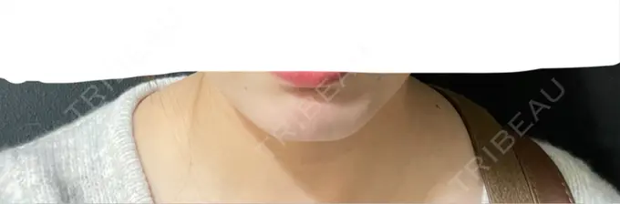 ボトックス（あご） / ヒアルロン酸注入（あご） HAAB×DREAM BEAUTY CLINIC 大阪梅田院 BEFORE メイン用