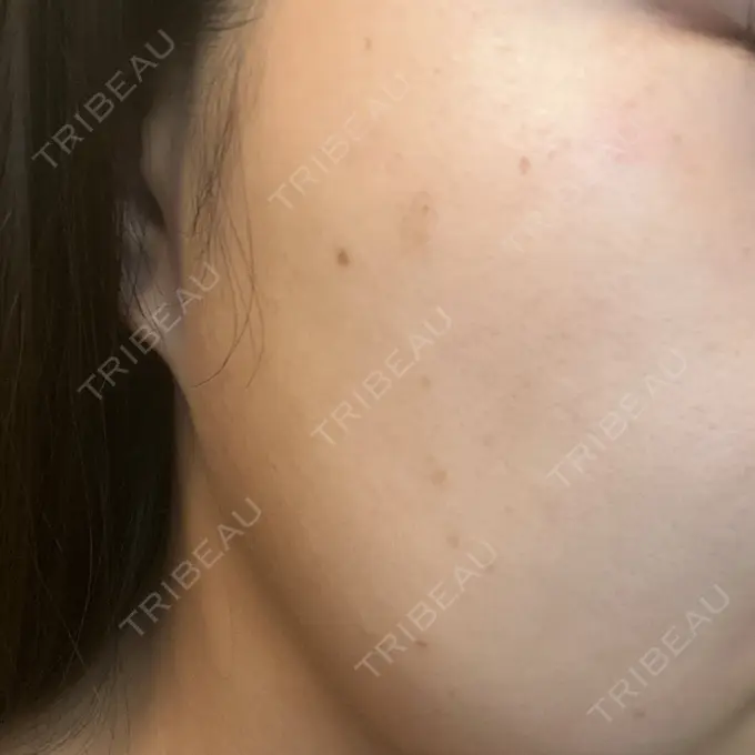 ピーリング（ハリ・ツヤ） / ルメッカ BITO BEAUTY CLINIC BEFORE メイン用